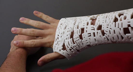 3D printed arm cast